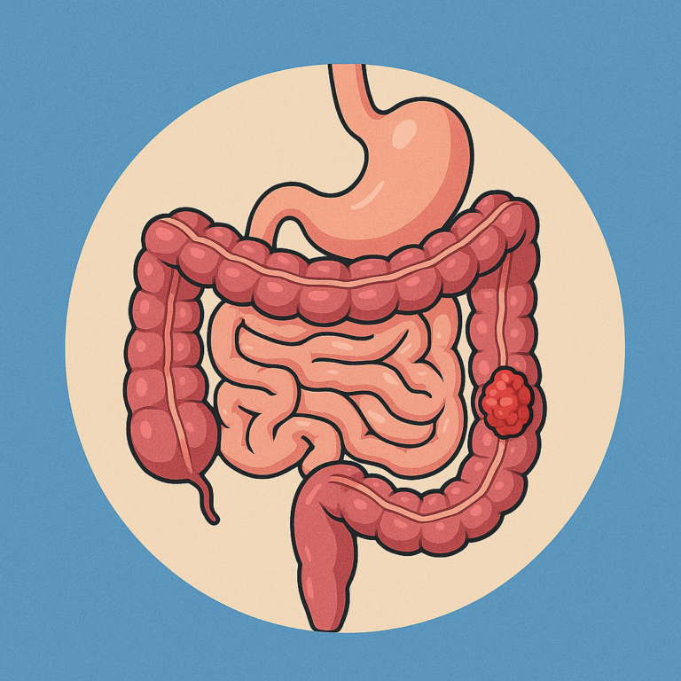 Cáncer Colorrectal: Todo lo que Necesitas Saber - Silvia Rodríguez