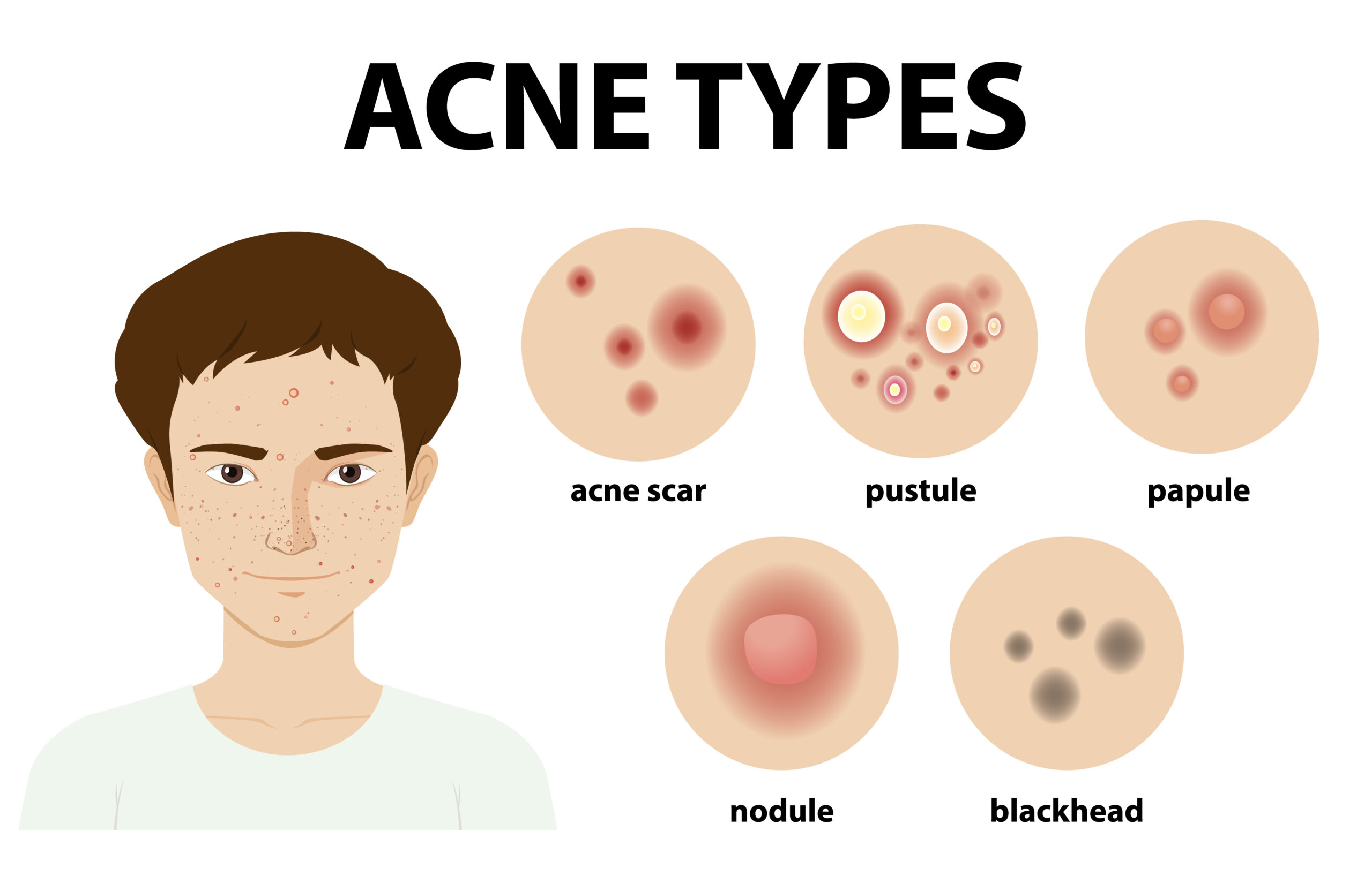 Types of acne on the skin or pimples